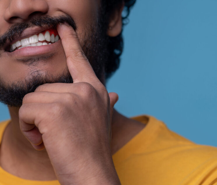 Cropped photo of a bearded mustached guy demonstrating his white teeth and red inflamed gums